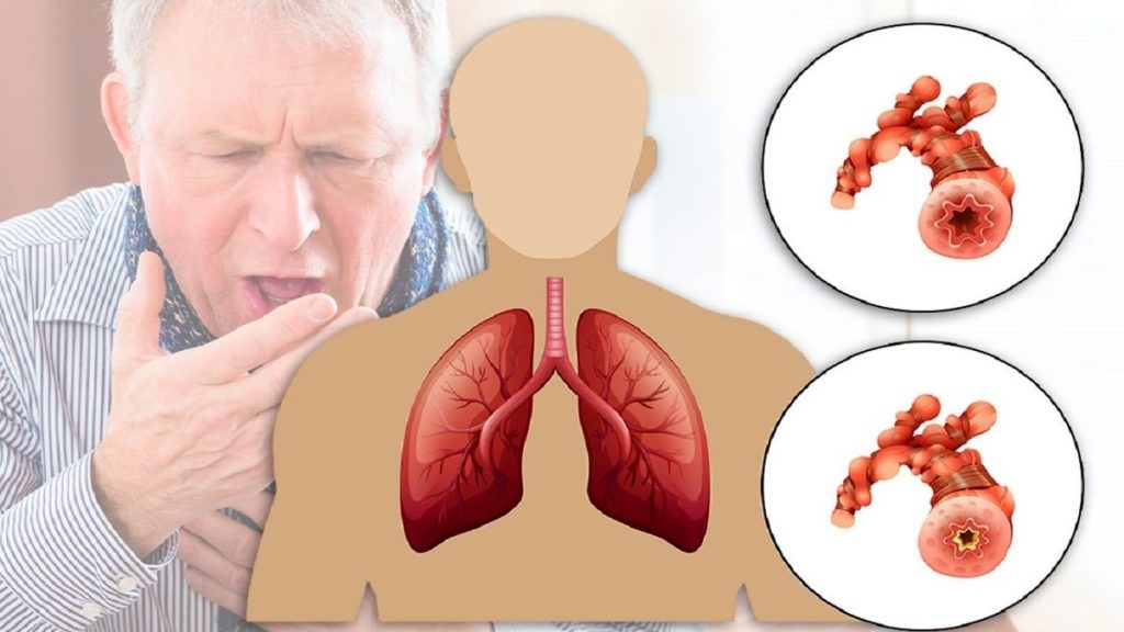 انسداد مزمن ریه یا COPD